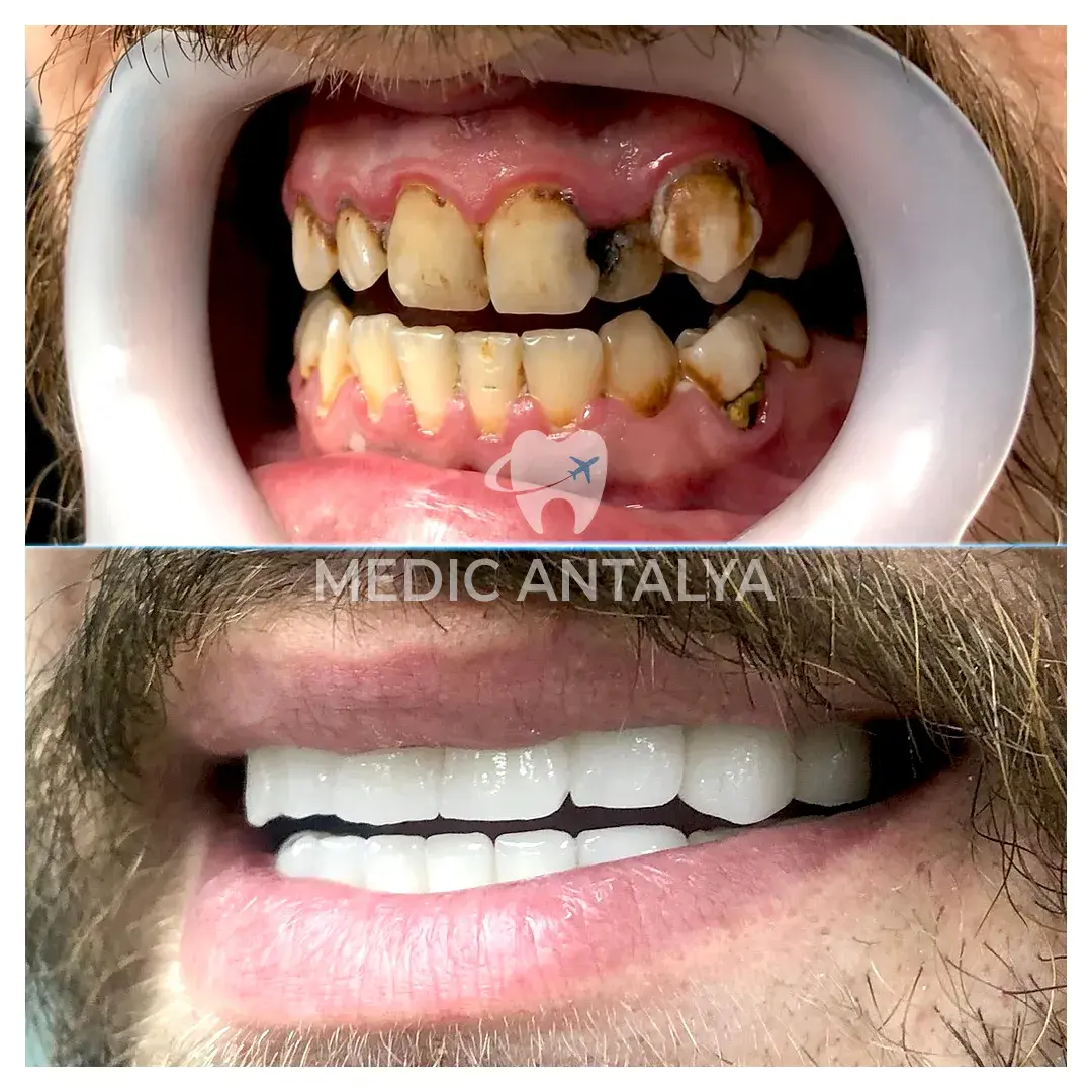 Erfahrungsbericht Zahnbehandlung Antalya